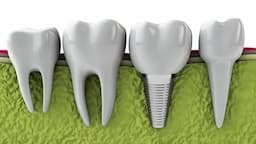 Стоматологічна послуга: Імплантація